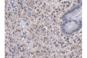 DAB staining on IHC-P; Samples: Human Colorectal cancer Tissue