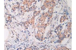DAB staining on IHC-P; Samples: Human Bile duct cancer Tissue) (Cathelicidin anticorps)