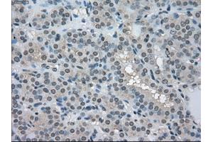 Immunohistochemical staining of paraffin-embedded Carcinoma of pancreas tissue using anti-LDHAmouse monoclonal antibody. (Lactate Dehydrogenase A anticorps)