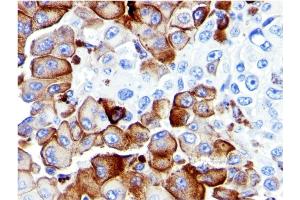 Formalin-fixed, paraffin-embedded human Melanoma stained with NGFR Mouse Monoclonal Antibody (NGFR5).