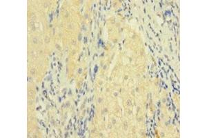 Immunohistochemistry of paraffin-embedded human liver cancer using ABIN7173813 at dilution of 1:100