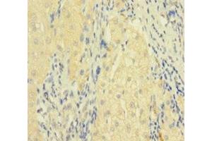 Immunohistochemistry of paraffin-embedded human liver cancer using ABIN7173813 at dilution of 1:100 (FASL anticorps  (AA 103-281))