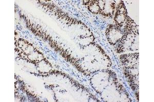 IHC-P: MCM2 antibody testing of human intestinal cancer tissue (MCM2 anticorps  (C-Term))