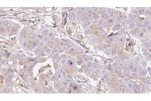 ABIN6272726 at 1/100 staining Human liver cancer tissue by IHC-P. (OR4D5 anticorps)