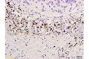 Formalin-fixed and paraffin embedded human endometrium carcinoma labeled with Anti-TIMP-4 Polyclonal Antibody, Unconjugated (ABIN668376) at 1:300, followed by conjugation to the secondary antibody and DAB staining (TIMP4 anticorps  (AA 161-224))