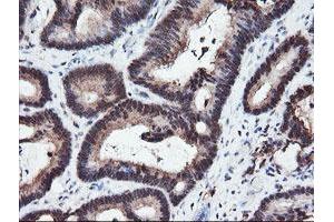 Immunohistochemical staining of paraffin-embedded Adenocarcinoma of Human colon tissue using anti-RFPL3 mouse monoclonal antibody. (RFPL3 anticorps)