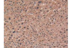 IHC-P analysis of Human Liver Cancer Tissue, with DAB staining. (TEK anticorps  (AA 1-116))