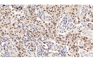 Detection of HDAC1 in Human Lung cancer Tissue using Monoclonal Antibody to Histone Deacetylase 1 (HDAC1)