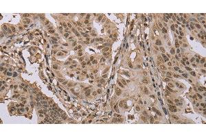 Immunohistochemistry of paraffin-embedded Human gastric cancer using CAB39 Polyclonal Antibody at dilution of 1:50 (CAB39 anticorps)