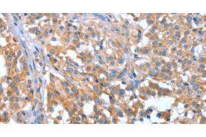 Immunohistochemistry of paraffin-embedded Human thyroid cancer tissue using NOD2 Polyclonal Antibody at dilution 1:40 (NOD2 anticorps)