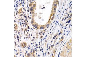 Immunohistochemistry of paraffin-embedded human stomach cancer using PTGIR antibody at dilution of 1:200 (400x lens). (Prostacyclin Receptor anticorps)