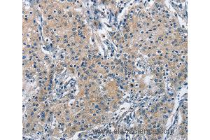 Immunohistochemistry of Human gastric cancer using TRIP4 Polyclonal Antibody at dilution of 1:50 (TRIP4 anticorps)