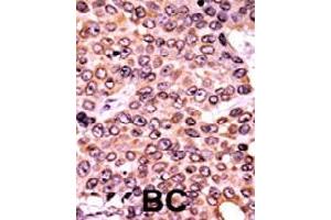 Formalin-fixed and paraffin-embedded human cancer tissue reacted with CDKN1A (phospho T145) polyclonal antibody  which was peroxidase-conjugated to the secondary antibody followed by AEC staining. (p21 anticorps  (pThr145))