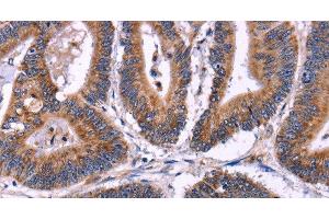 Immunohistochemistry of paraffin-embedded Human colon cancer using SIGLEC5 Polyclonal Antibody at dilution of 1:30 (SIGLEC5 anticorps)