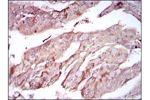 Immunohistochemical analysis of paraffin-embedded rectum cancer tissues using PON1 mouse mAb with DAB staining.