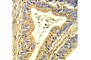 IHC analysis of FFPE human colon carcinoma stained with SOD1 antibody
