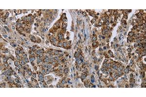 Immunohistochemistry of paraffin-embedded Human liver cancer using GOT2 Polyclonal Antibody at dilution of 1:50
