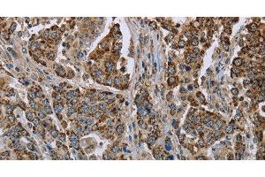 Immunohistochemistry of paraffin-embedded Human liver cancer using GOT2 Polyclonal Antibody at dilution of 1:50 (GOT2 anticorps)