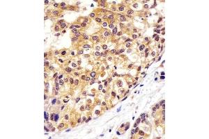 (ABIN6242610 and ABIN6577131) staining VCP in human breast carcinoma sections by Immunohistochemistry (IHC-P - paraformaldehyde-fixed, paraffin-embedded sections).