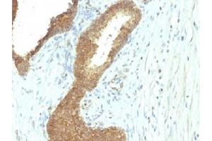 IHC testing of FFPE human colon carcinoma with Alkaline Phosphatase antibody (ALPL/597). (Alkaline Phosphatase anticorps)