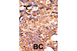 Formalin-fixed and paraffin-embedded human cancer tissue reacted with the primary antibody, which was peroxidase-conjugated to the secondary antibody, followed by AEC staining.