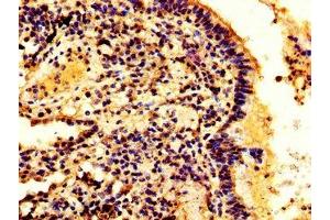 IHC image of ABIN7155213 diluted at 1:300 and staining in paraffin-embedded human lung cancer performed on a Leica BondTM system.