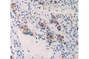 IHC-P analysis of prostate gland cancer tissue, with DAB staining. (GALC anticorps  (AA 375-535))