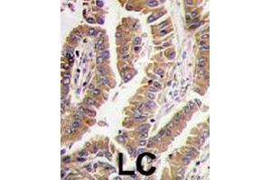 Formalin-fixed and paraffin-embedded human lung carcinoma tissue reacted with BMP4 polyclonal antibody  , which was peroxidase-conjugated to the secondary antibody, followed by DAB staining. (BMP4 anticorps  (N-Term))