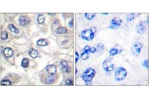 Immunohistochemistry analysis of paraffin-embedded human breast carcinoma tissue, using BAD (Cleaved-Asp71) Antibody.
