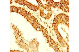 Immunohistochemistry of paraffin-embedded human endometrial cancer using ABIN7158700 at dilution of 1:100 (KDM4C anticorps  (AA 450-600))