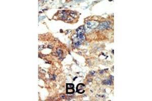 Formalin-fixed and paraffin-embedded human cancer tissue reacted with the primary antibody, which was peroxidase-conjugated to the secondary antibody, followed by AEC staining. (PI4KB anticorps  (N-Term))