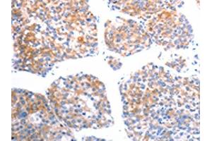 The image on the left is immunohistochemistry of paraffin-embedded Human liver cancer tissue using ABIN7192492(SLC44A1 Antibody) at dilution 1/25, on the right is treated with synthetic peptide. (SLC44A1 anticorps)