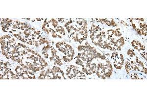 Immunohistochemistry of paraffin-embedded Human esophagus cancer tissue using ZNF486 Polyclonal Antibody at dilution of 1:50(x200) (ZNF486 anticorps)