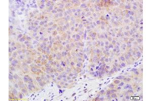 Formalin-fixed and paraffin embedded human bladder carcinoma labeled with Rabbit Anti-Claudin 17 Polyclonal Antibody, Unconjugated  at 1:200 followed by conjugation to the secondary antibody and DAB staining (Claudin 17 anticorps  (AA 29-81))