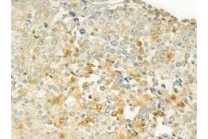ABIN6266025 and ABIN6277652 at 1/100 staining human prostate carcinoma by IHC-P. (WHSC1L1 anticorps  (N-Term))