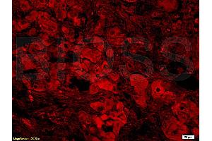 Formalin-fixed and paraffin-embedded: Human nasopharyngeal carcinoma labeled with Rabbit Anti-BAFF/CD257 Polyclonal Antibody, Unconjugated (ABIN740175) 1:400 followed by conjugation to the secondary antibody and DAB staining