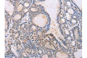 The image on the left is immunohistochemistry of paraffin-embedded Human thyroid cancer tissue using ABIN7130592(PFN4 Antibody) at dilution 1/20, on the right is treated with fusion protein. (Profilin 4 anticorps)