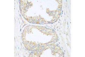 Immunohistochemistry of paraffin-embedded human prostate using SGCB antibody at dilution of 1:100 (40x lens). (SGCB anticorps)