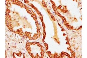 IHC image of ABIN7177373 diluted at 1:100 and staining in paraffin-embedded human prostate cancer performed on a Leica BondTM system.