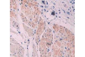 IHC-P analysis of stomach cancer tissue, with DAB staining. (Supervillin anticorps  (AA 1385-1525))