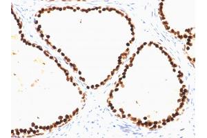 Formalin-fixed, paraffin-embedded human Prostate Carcinoma stained with FOXA1 Mouse Monoclonal Antibody (FOXA1/1515). (FOXA1 anticorps  (AA 372-472))
