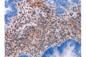 Detection of VIM in Human Colorectal cancer Tissue using Monoclonal Antibody to Vimentin (VIM)