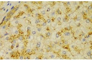 Immunohistochemistry of paraffin-embedded Human liver cancer using ACTN1 Polyclonal Antibody at dilution of 1:100 (40x lens). (ACTN1 anticorps)