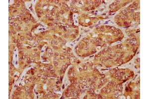 IHC image of ABIN7169059 diluted at 1:1200 and staining in paraffin-embedded human liver cancer performed on a Leica BondTM system.