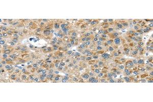 Immunohistochemistry of paraffin-embedded Human liver cancer tissue using USP9X Polyclonal Antibody at dilution 1:40 (USP9X anticorps)
