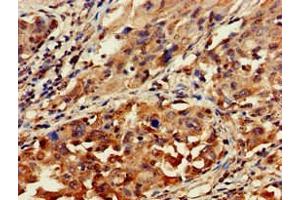 Immunohistochemistry of paraffin-embedded human lung cancer using ABIN7154711 at dilution of 1:100 (GNAT1 anticorps  (AA 92-170))