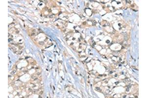 The image on the left is immunohistochemistry of paraffin-embedded Human breast cancer tissue using ABIN7192347(SGPL1 Antibody) at dilution 1/25, on the right is treated with synthetic peptide. (SGPL1 anticorps)