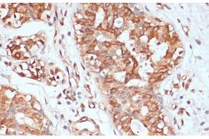 Immunohistochemistry of paraffin-embedded Human mammary cancer using PTPRN2 Polyclonal Antibody at dilution of 1:100 (40x lens). (PTPRN2 anticorps)