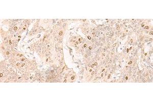 Immunohistochemistry of paraffin-embedded Human esophagus cancer tissue using IL7 Polyclonal Antibody at dilution of 1:30(x200) (IL-7 anticorps)