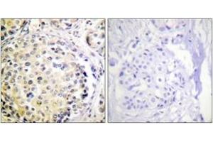 Immunohistochemistry analysis of paraffin-embedded human breast carcinoma tissue, using Vimentin (Ab-56) Antibody. (Vimentin anticorps  (AA 31-80))